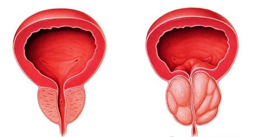 河池前列腺增生会不会复发 河池前列腺增生会不会复发