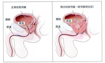 什么是前列腺炎增生 什么是前列腺炎增生